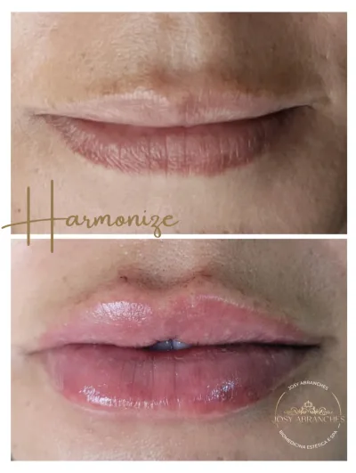 Preenchimento Labial com Ácido Hialurônico