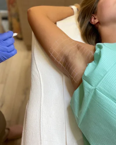 Tratamento botox para Hiperidrose (Suor Excessivo)